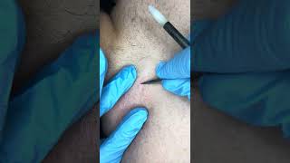 Watch electrolysis Back hairs permanent hair removal [upl. by Alisa]