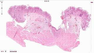 Peptic Ulcer  Histopathology [upl. by Savell]