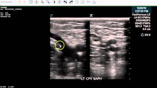 Positive LE DVT Exam  Case Study [upl. by Almeta798]