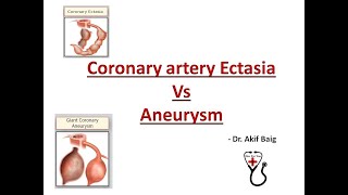 Coronary Ectasia Vs Aneurysm Dr Akif Baig [upl. by Elletsirk]