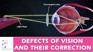 DEFECTS OF VISION AND THEIR CORRECTION [upl. by Ecylla386]