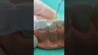 Resina dental con guía de silicona [upl. by Gaspard128]