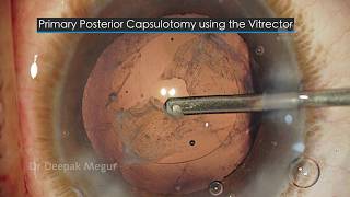 Primary Posterior Capsulotomy by using a vitrector The Secrets Dr Deepak Megur [upl. by Jacinta]