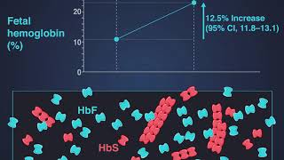 Hydroxyurea for Sickle Cell Anemia [upl. by Etezzil]