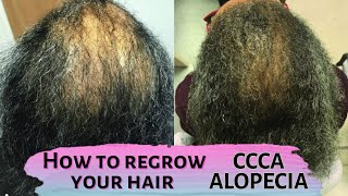 How to regrow your hair  CCCA Alopecia Central Centrifugal Cicatricial Alopecia hair care [upl. by Nowaj]