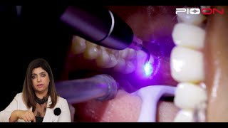 Excision of soft tissue Operculectomy by Pioon S1 Dental Diode Laser [upl. by Anissa]