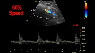 Abdominal Aorta Color Doppler [upl. by Billye872]