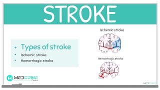 Stroke Definition Classification Causes Symptoms Diagnosis and Treatment [upl. by Athene]