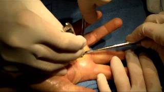 Trigger Finger Release with Cyst Excision [upl. by Kulseth792]