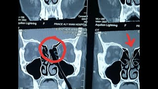 MENINGOCELE Cribriform CSF leak explained on CT PNS  CT PNS made simple A to Z DrAjinkya Kedari [upl. by Burck]