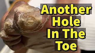 Another Hole In The Toe Ulcer Fungal Toenails and Calluses [upl. by Susette]