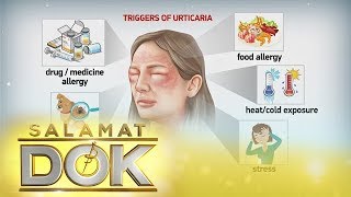 Salamat Dok Causes and symptoms of urticaria [upl. by Hilbert478]