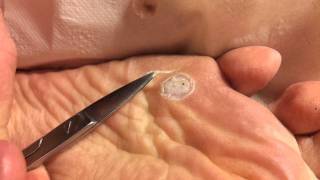 Removal of foot plantar wart with acid part 23 [upl. by Onaireves]