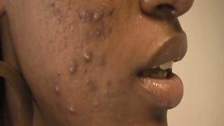 The Acne Practice severe case 3 [upl. by Enneillij126]