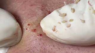 Acne Treatment Huong Da Nang  2024 blackheads 707 [upl. by Lynn]