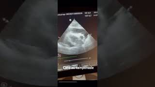 Cardiac tamponadecardiology echocardiography science medicine ultrasound [upl. by Aicilic]