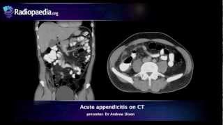 Acute appendicitis on CT  radiology video tutorial [upl. by Felty]