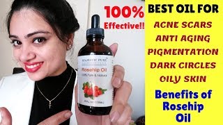 Best oil for removing Acne Scars  Dark Circles  Pigmentation  Madams Choice [upl. by Samy]