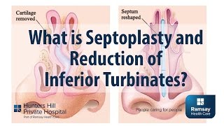 What is Septoplasty and reduction of Inferior Turbinates [upl. by Livvy]