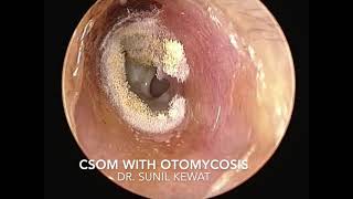 Otomycosis with CSOM  Fungus in ear with perforated Tympanic Membrane [upl. by Naynek]