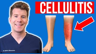 Doctor explains CELLULITIS skin infection  Causes symptoms treatment plus photos [upl. by Eiramesor]