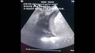 ascites amp pleural effusion복수흉수 [upl. by Demahom]