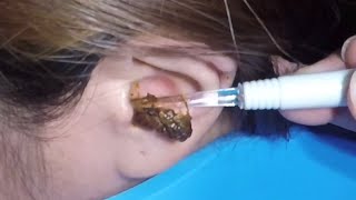 The Most Massive Earwax Removed in One Scoop [upl. by Einnhoj]