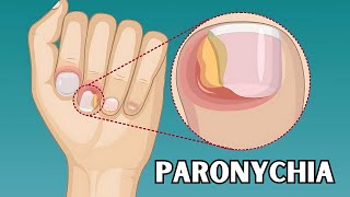 Paronychia  Causes Risk Factors Signs amp Symptoms Treatment  Everything You Need To Know [upl. by Aryamoy]