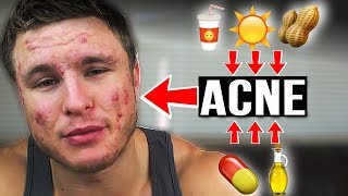 Does THIS Cause Acne  Diet Sodas Sun Nuts amp More EP 3 [upl. by Erodisi359]