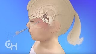 Endoscopic Neurosurgery for Brain Tumors in Children [upl. by Yanetruoc65]