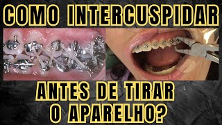 Como fazer a intercuspidação antes de remover o aparelho ortodôntico Aula 211 [upl. by Snow]