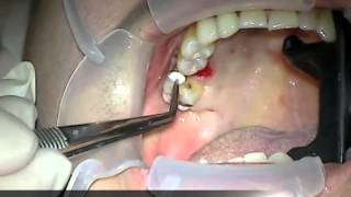 IDI Dental Implant Immediate Placement amp Immediate Impression with LFM [upl. by Teodor]