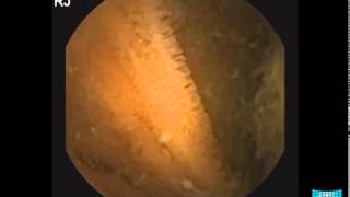 Small Bowel Tumor Detection in Capsule Endoscopy [upl. by Rivera389]