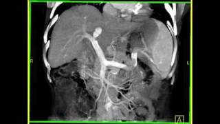 Abdomen Liver Cirrhosis 3D Volume rendering of a cirrhotic liver with collaterals [upl. by Grubb]