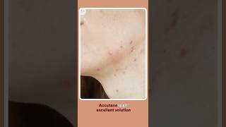 Accutane amp Skincare Essential Tips for Treating Acne [upl. by Antrim]