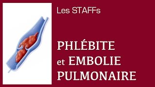 Phlébite et Embolie pulmonaire  12  STAFFs Saint Camille [upl. by Aleihs596]