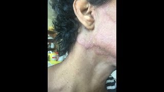 Psoriasis TreatmentCleared my skin in less than 8 weeks  2019 [upl. by Haron]