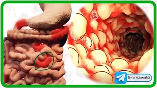 Inflammatory bowel disease IBD  Crohns disease and Ulcerative colitis [upl. by Atirac12]