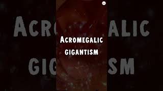 Acromegalic Gigantism How a Tumor Turns You Into a Giant [upl. by Ayouqat]