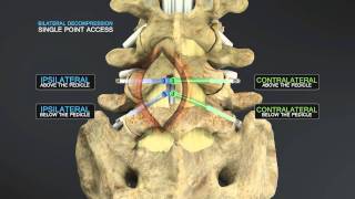 Medical Animation of Lumbar Stenosis Decompression [upl. by Lennard822]