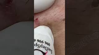 Blackhead Removal Acne Removal Treatment 07 [upl. by Gaddi]