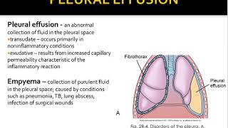 pleural eff pleurisy atelectasis [upl. by Meehar]