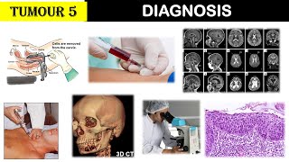 Tumour 5  Diagnosis of TumoursCancers  Biopsy  CT Scan  MRI  FNAC  Tumour Markers [upl. by Elazaro]