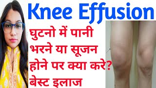 Knee Effusion  घुटने में पानी भरनासूजन का इलाज  Knee Effusion Causes And Treatment  Swollen Knee [upl. by Starobin976]