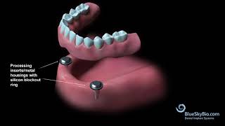 Overdenture Chairside Technique [upl. by Timi]