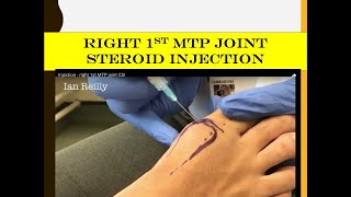 Injection  right 1st MTP joint CSI [upl. by Yesdnik]