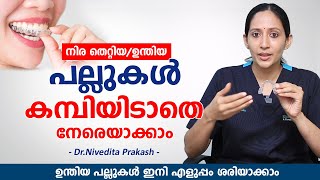 ഉന്തിയ പല്ലുകൾ ഇനി എളുപ്പം നേരയാകാം കമ്പിയിടാതെ  Clear Aligners for Teeth  Elite Dental Studio [upl. by Petrie]