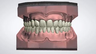 3Shape Dental System  Full Denture Design [upl. by Alliuqat931]