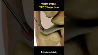 Wrist Pain  TFCC Injections [upl. by Sesmar]