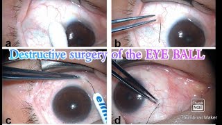 DESTRUCTIVE SURGERY OF THE EYE BALL   Eviceration  Enucleation  Exentration [upl. by Berns]